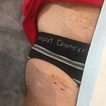 2 Week scar after bikini hip replacement