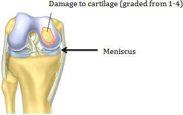 Damaged Articular Cartilage