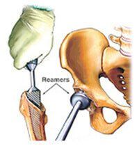 Femur (thigh Bone) and Acetabulum (Cup) is prepared – (Reaming)