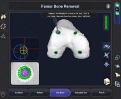 femur-bone-removal