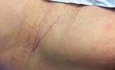 6 Week scar after bikini hip replacement