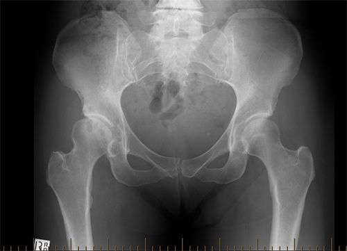 Anterior hip Replacement
