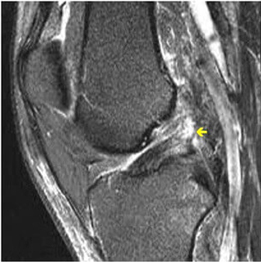 MRI Scan Showing ACL Rupture