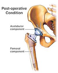 Prosthesis inserted