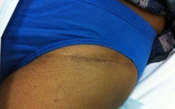Scar few weeks Surgery Left Hip