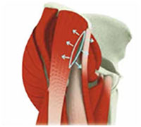Surgical steps of anterior hip replacement